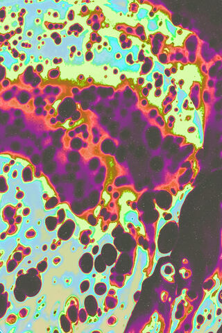 The Colorful World of Leprosy: A Microscopic View 🌈🔬