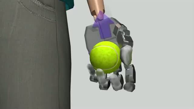 Feeling bionic hand amputee first to use bionic prosthesis